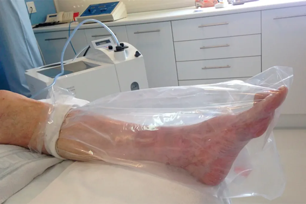 Ozonoterapia para úlceras