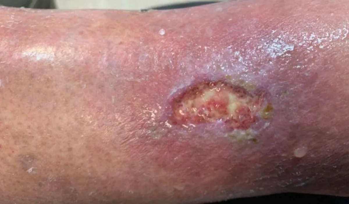 Úlcera vascular