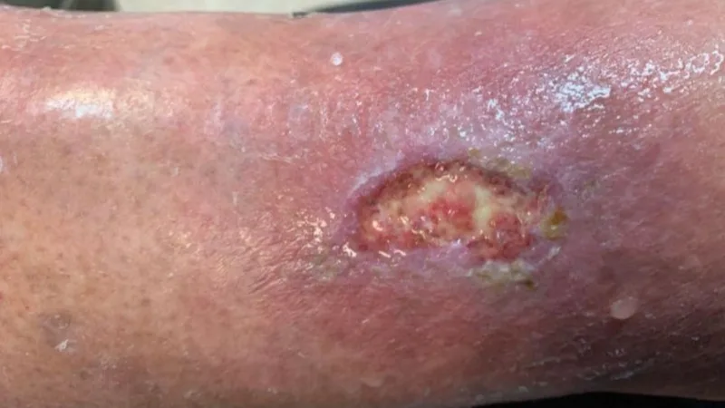 Úlcera vascular